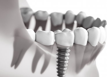 Виды имплантации зубов: одномоментная и отсроченная