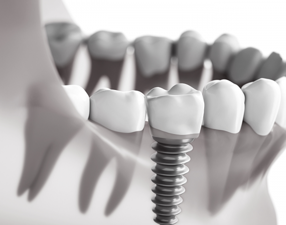 Виды имплантации зубов: одномоментная и отсроченная