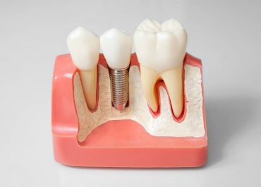 Виды протезирования зубов: плюсы и минусы