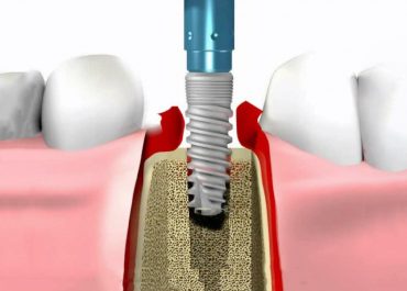 PRF при имплантации зубов. наращивание костной ткани в стоматологии